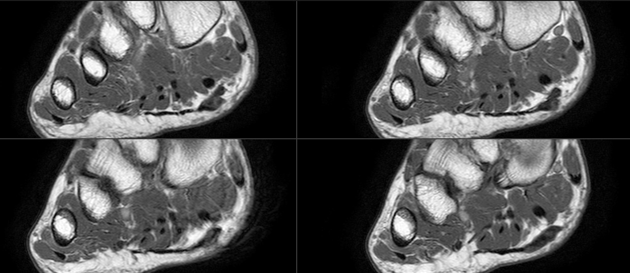 Figure 3 for case Plantar fibromatosis